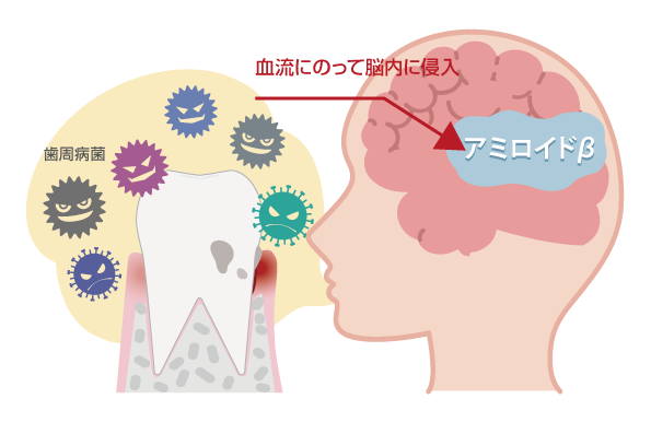 歯周病からアルツハイマー型認知症になるメカニズム