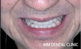 手術後の歯並び