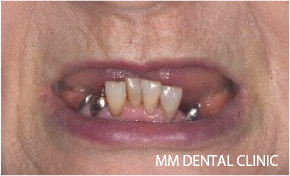治療前の患者様のお口周りの写真-1