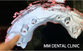 仮歯のデジタルスキャナー