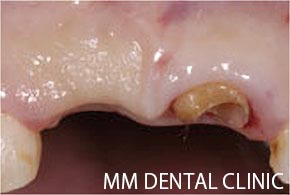 抜歯後にインプラントを右側の歯がない部位に埋入