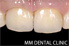 前歯１本欠損 症例-治療後