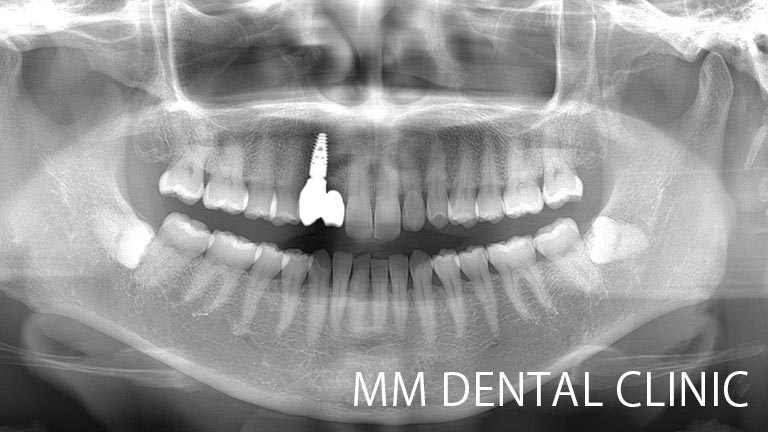 上顎2本の先天性欠損を1本のインプラントで治療した症例（レントゲン写真）