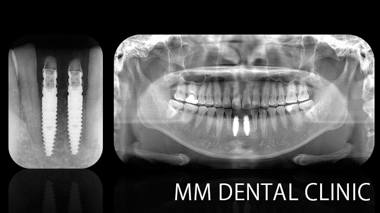 マウスピース矯正でスペースを作り、インプラントを埋入した症例（レントゲン写真）