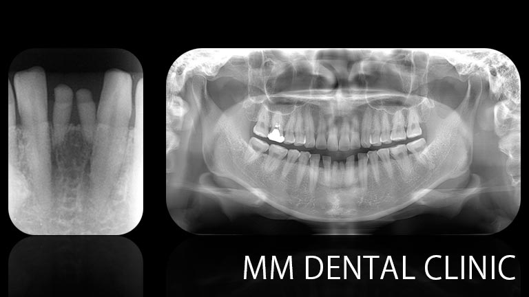 マウスピース矯正でスペースを作り、インプラントを埋入した症例（レントゲン写真）