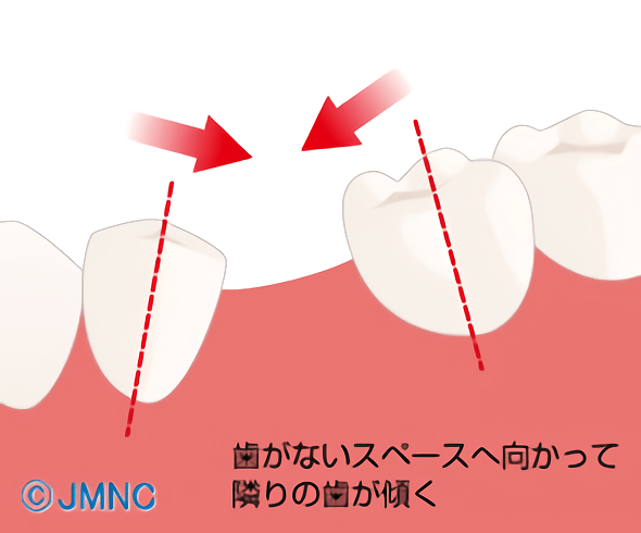 両隣の歯が倒れてくる