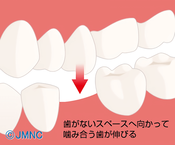 歯が伸びてくる