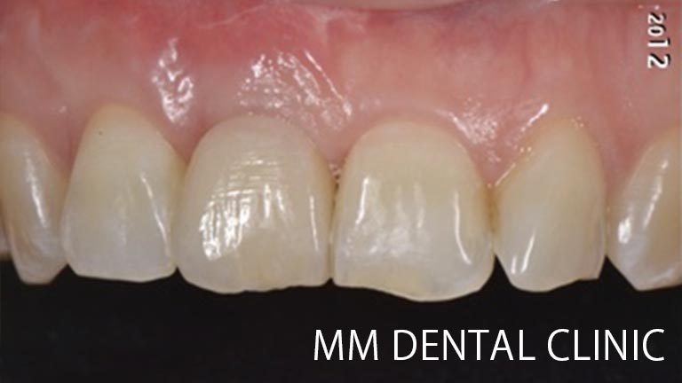 前歯部の審美インプラント治療症例-治療後