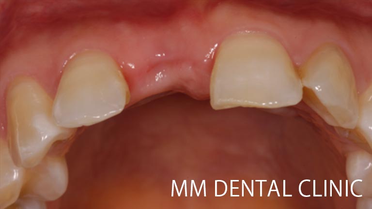 前歯部の審美インプラント治療症例-治療前