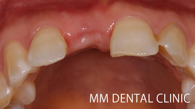 審美的インプラント治療症例