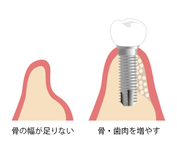 組織再生