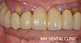 上下オールオン4/6症例-治療前