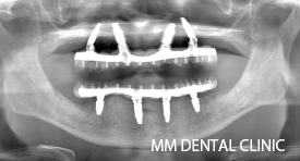 上下オールオン4症例-治療後