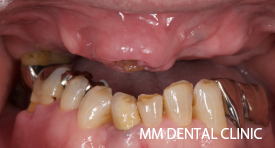 口蓋裂の方のオールオン4症例-治療前