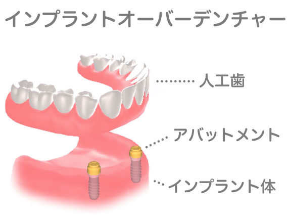 オーバーデンチャーの仕組みイラスト