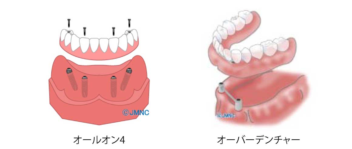 オールオン4とオーバーデンチャーの比較イラスト