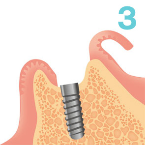 インプラントを埋入します