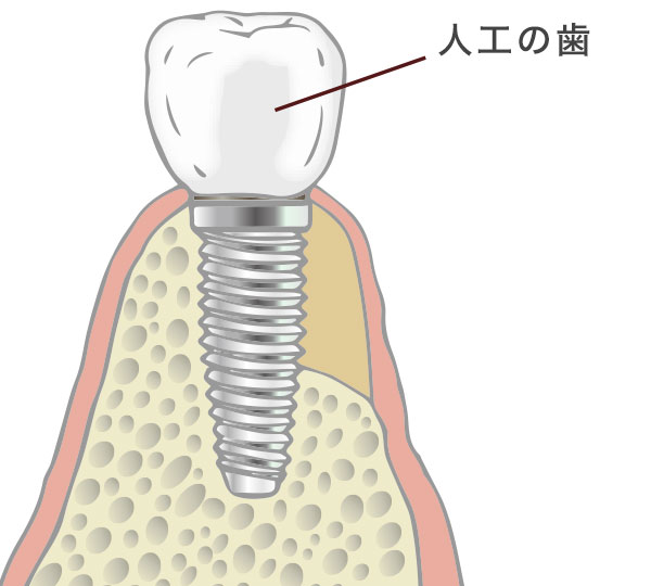 GBR工程3