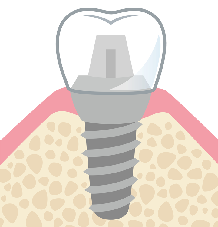 インプラントの構造図