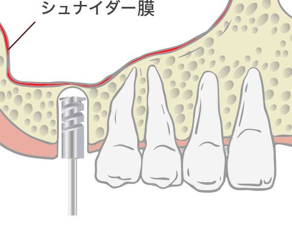 ソケットリフト工程1