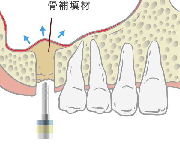 ソケットリフト工程2