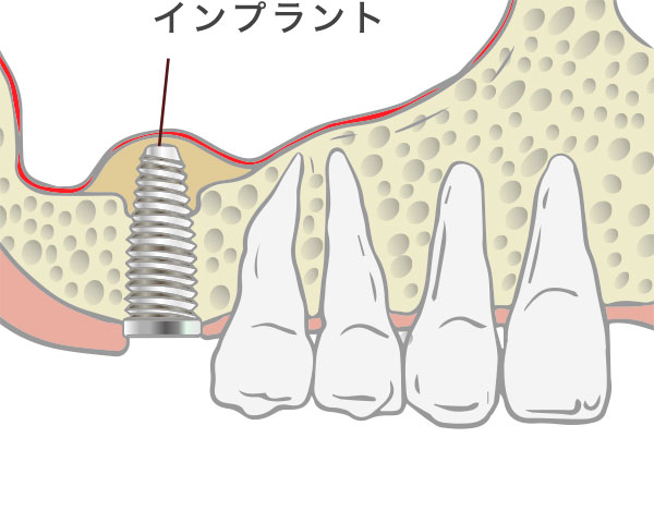 ソケットリフト工程3