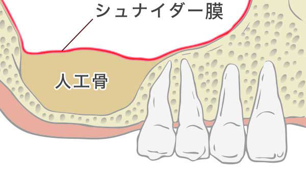 サイナスリフト工程2