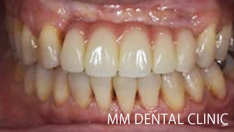外傷で歯を失った方のインプラント症例-治療後