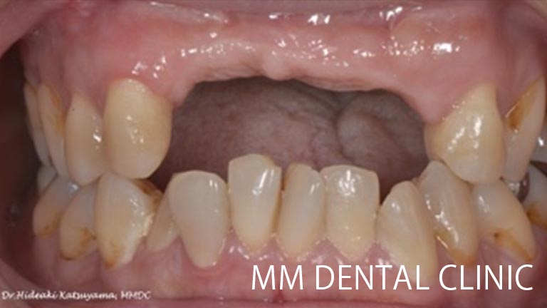 交通事故により歯を失った症例