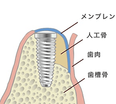 組織再生（骨造成・歯肉増生）を併用したインプラント治療